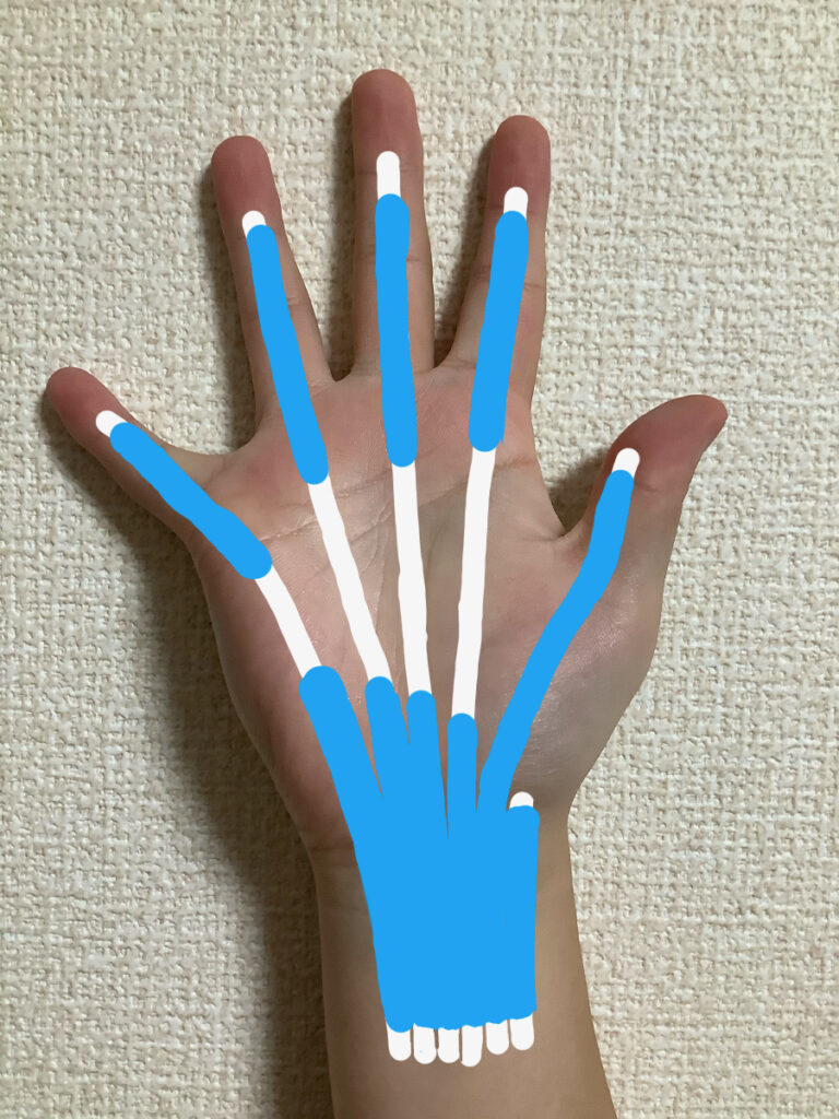 手掌側の腱鞘が母指に伸びているパターン