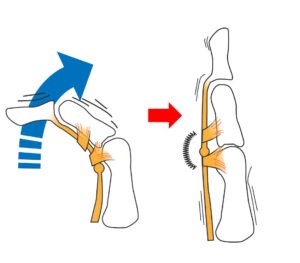 ばね指の機構です。線維化し硬くなってしまった腱鞘内を肥厚した屈筋腱がうまく滑走できないことで起こります。