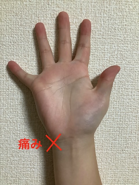 手首の関節の小指側に痛みが生じる腱鞘炎を尺側手根伸筋腱炎といいます。TFCC損傷を併発している場合もあります。