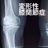 膝の痛みの最終形、変形性膝関節症の原因と対処法について解説！