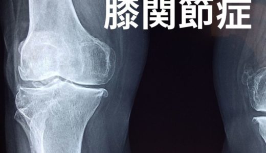 膝の痛みの最終形、変形性膝関節症の原因と対処法について解説！