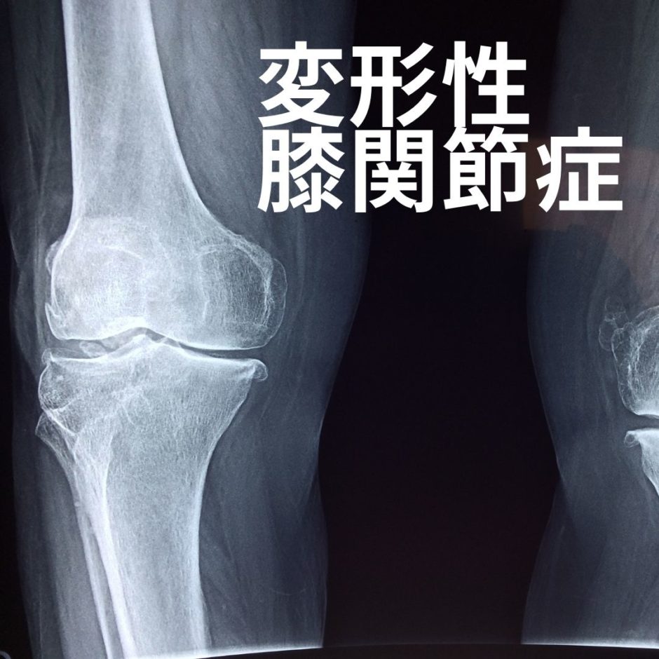 変形性膝関節症のレントゲン画像