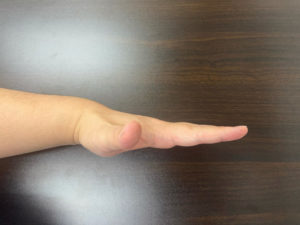 手関節正中位での手指伸展位