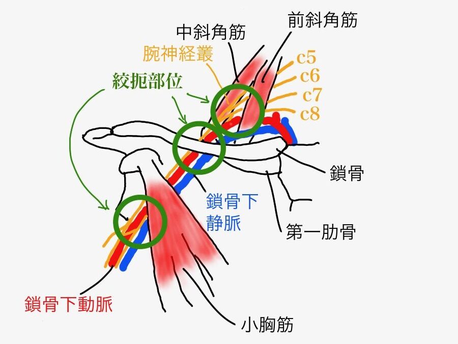 胸郭出口症候群は、首から鎖骨にかけて神経と血管の圧迫が起こることで脱力感やしびれが起こる