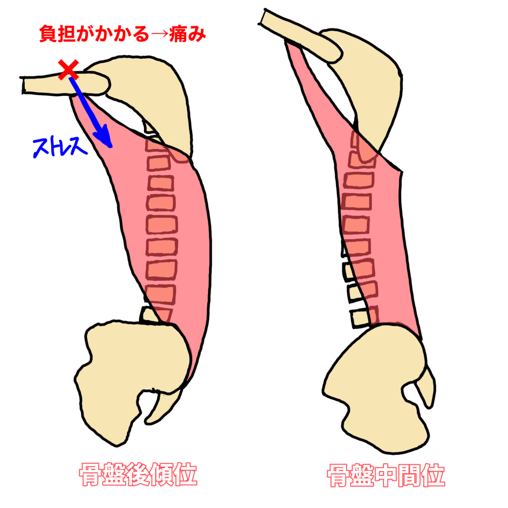 腰を丸めて座ったときに広背筋が緊張することで、停止部位である上腕骨を下後方へ引く負担がかかるようになります。フルート・ピアノ・チェロなど楽器演奏で腕の負担が増える原因のひとつです。