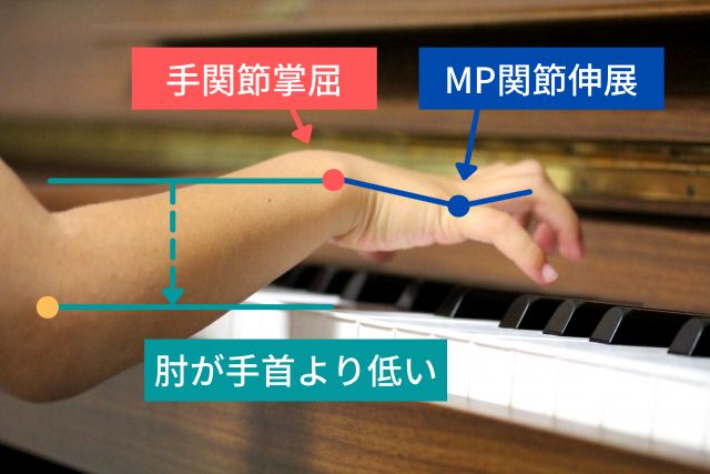 肘関節が手関節よりも低いポジションでピアノ演奏することで手関節が掌屈しやすくなります。その状態で打鍵を行うとMP関節を伸展させて鍵盤から指を離すことが多くなります。すると指を曲げる筋肉だけでなく、指を伸ばす筋肉も疲労しやすくなり、手関節への圧迫ストレスが増えてTFCC損傷につながると考えられます。
