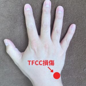 TFCC損傷が起きると痛みが出る部分を表しています。
