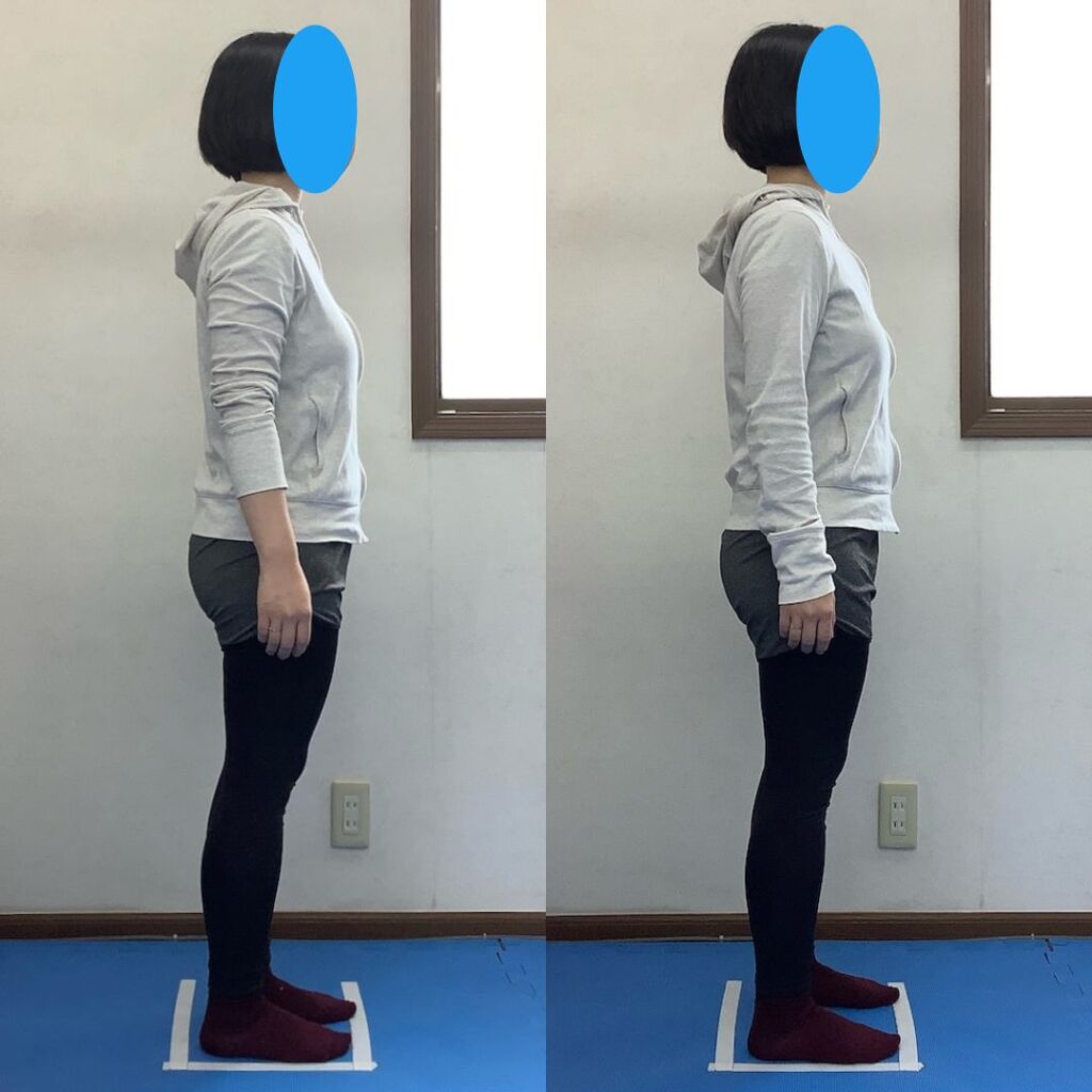 整体サロンHarmoniaをご利用いただいているフルート奏者の方の反り腰に対する施術の左側before、右側afterの写真です。つま先重心の立ち方から重心が後ろへ移動し、骨盤前傾も少なくなり反り腰が緩和しています。