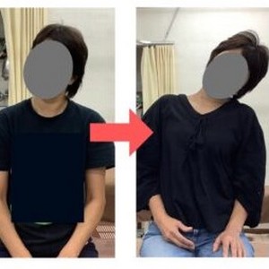 首こり・肩こりの症状が強く首が動かなかった方が隔週で2回の施術でみられた変化を比較した写真です。
