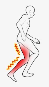 腰部脊柱管狭窄症や腰椎すべり症は、立っていたり歩いていたりすると脚に痛みやしびれが出現し、休憩するとその症状が落ち着くという特徴があります。