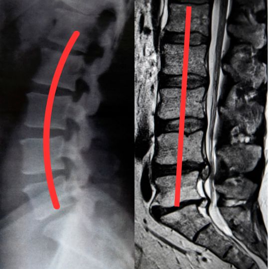 腰椎の生理的前弯と真っ直ぐになってしまった人のレントゲンを比較した写真です。