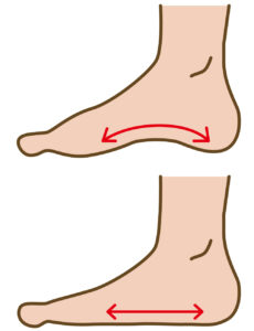 正常な土踏まずと扁平足の比較