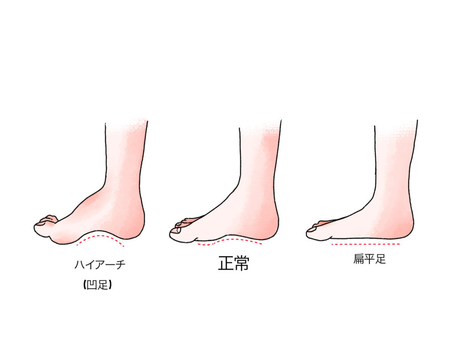 足底の形状のイラスト。ハイアーチ・正常・扁平足