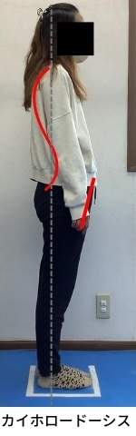 楽器演奏時の反り腰、原因と解決策を徹底解説!【理学療法士が解説】 3 猫背と反り腰が合わさった姿勢であるカイホロードーシスの写真です。
背中は丸まり、骨盤が前傾し腰が反っているのがわかります。
楽器奏者で間違った呼吸法をしている方に多い姿勢です。