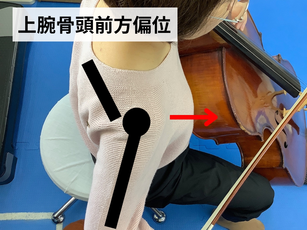 巻き肩を伴った状態で演奏することで起こる上腕骨頭前方偏位を示した写真