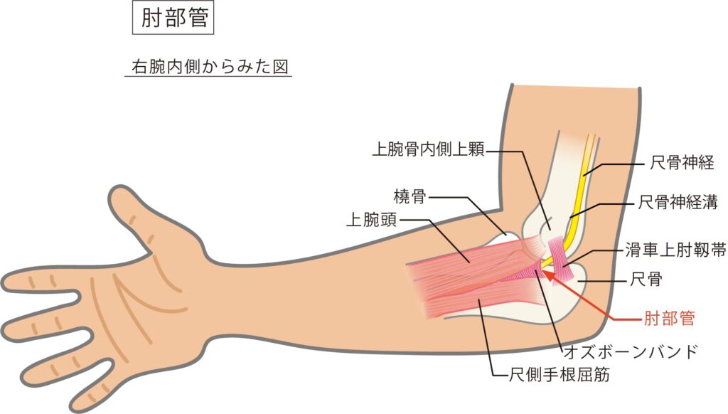肘部管の場所を示したイラストです。尺側手根屈筋の腱膜であるオズボーンバンドと呼ばれる尺骨神経をスムーズに移動させるためのトンネル組織や滑車上肘靭帯という尺骨神経