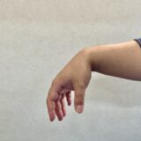 橈骨神経障害が重度になると撓骨神経麻痺を起こし下垂手を引き起こします。