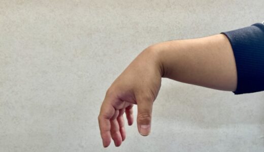 橈骨神経障害が重度になると撓骨神経麻痺を起こし下垂手を引き起こします。