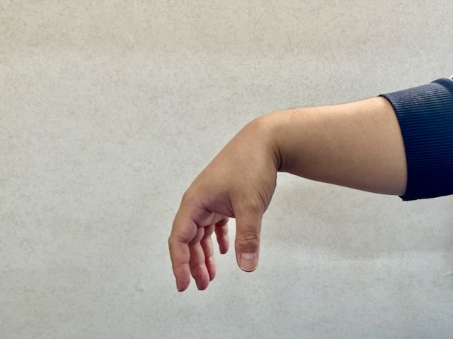 橈骨神経障害の痛み、しびれに悩まない!原因と対策を解説! 2 橈骨神経障害が重度になると撓骨神経麻痺を起こし下垂手を引き起こします。