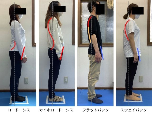 あなたの姿勢はどのタイプ?【猫背・反り腰】と【肩こり・腰痛】の意外な関係 2 ケンダルの姿勢分類に則った人の姿勢の違いを実際の人の姿勢で分類しています。ロードーシス、カイホロードーシス、フラットバック、スウェイバックがあります。