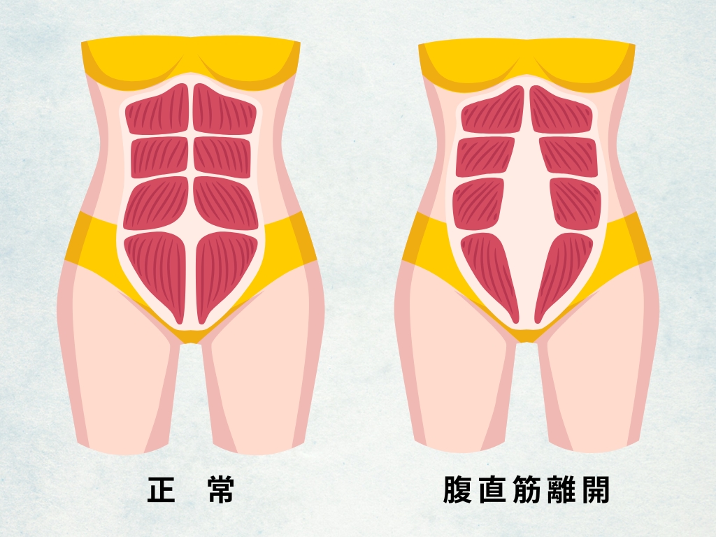 正常な腹直筋と産後の腹直筋離開を示したイラストです。腹直筋離開は、理解の仕方によって5つの種類に分類されます。